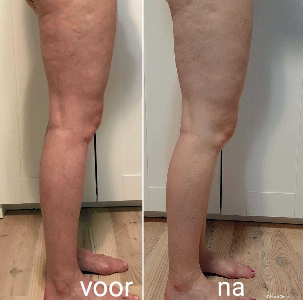 wat helpt tegen cellulite